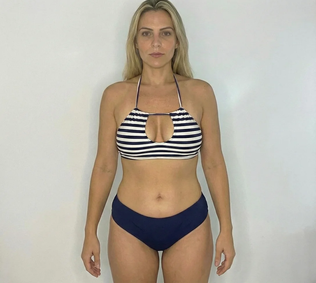 Fernanda Souza - Paciente Slima